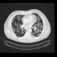Amiodarone lung, toxic pneumonitis: CT - Computed tomography